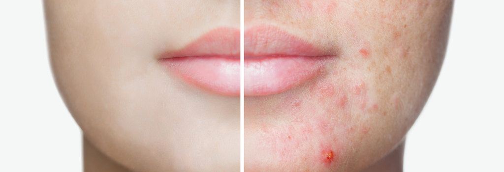 6 Tips on How to Deal with Acne
